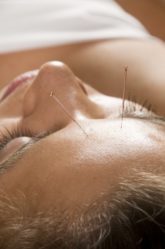 Woman getting an acupuncture treatment 