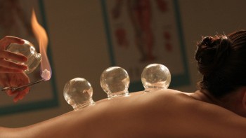 Acupuncture-Cupping-with-Fire-closer-crop