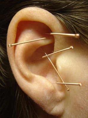 ear accupuncture
